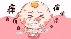 儿童湿疹怎么治疗