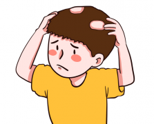 斑秃的治疗方法有哪些