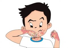 牛皮癣刚长出来的图片